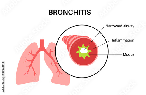 Bronchitis lung disease