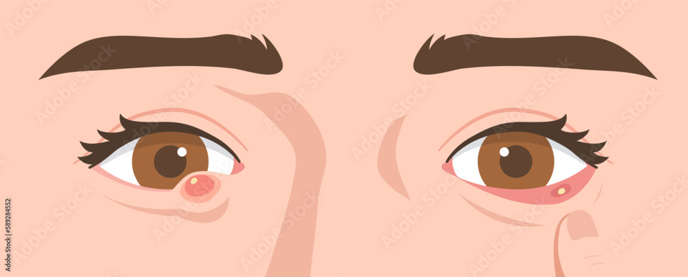 Illustration of eyes with external and internal stye. Concept of infectious eye, Hordeolum, Ophthalmology, infection, health, medicine. Flat vector illustration. Illustration of eyes with external and internal stye. Concept of infectious eye, Hordeolum, Ophthalmology, infection, health, medicine. Flat vector illustration.