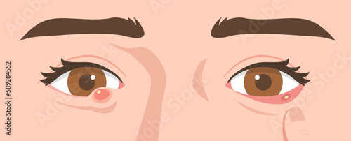 Illustration of eyes with external and internal stye. Concept of infectious eye, Hordeolum, Ophthalmology, infection, health, medicine. Flat vector illustration.