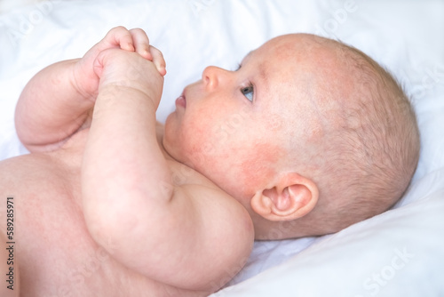 a baby boy with red irritated marks near left ear and cheek, atopic dermatitis, blisters on sensitive skin, a child laying holding hands on a white cloth with inflamed skin on his face, head, forehead