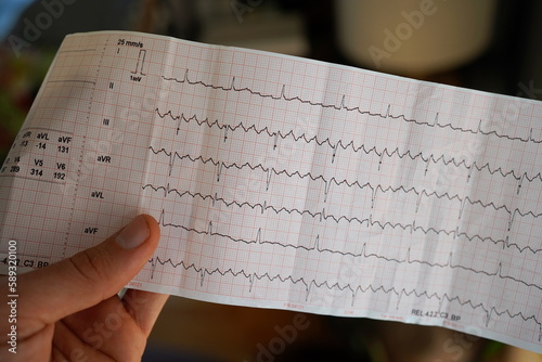 Hand holding a real electrocardiogram with atrial flutter.  photo