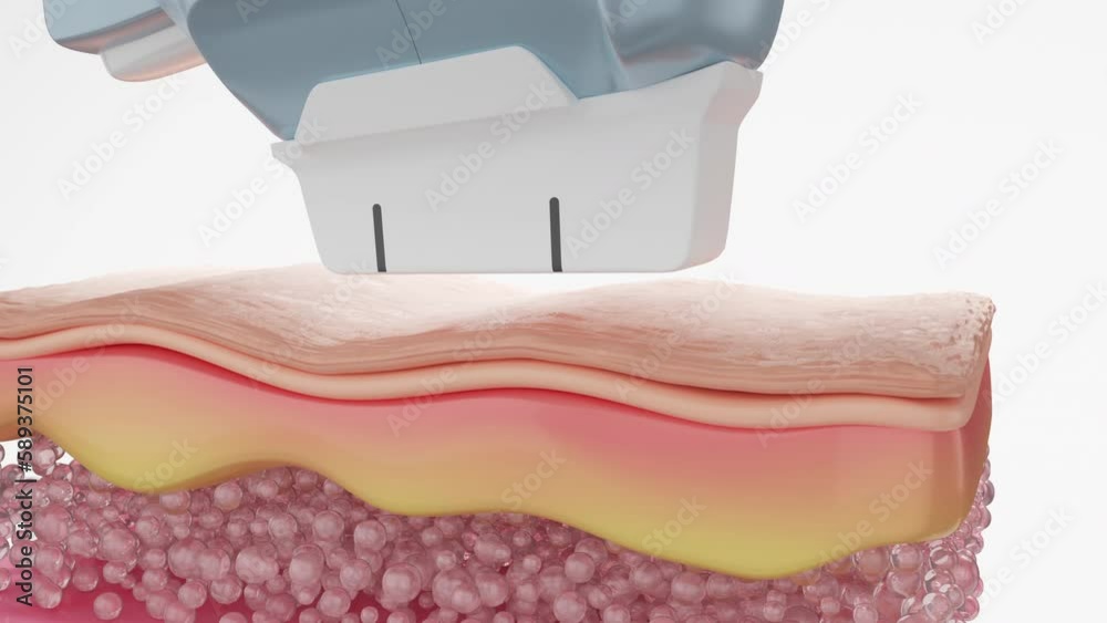 HIFU laser machine shot laser to SMAS layer to stimulate collagen and return firmness to old skin. Facial laser treatment concept. 3D rendering.