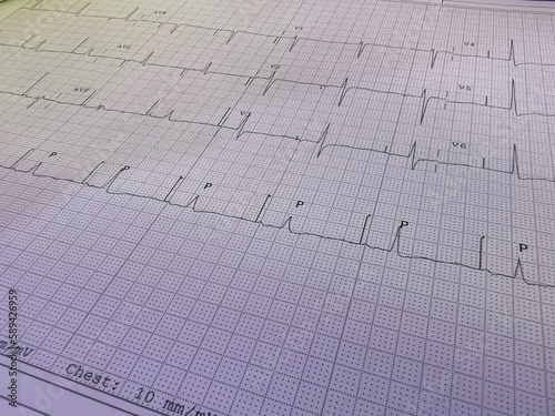 Close up of an electrocardiogram in paper form.