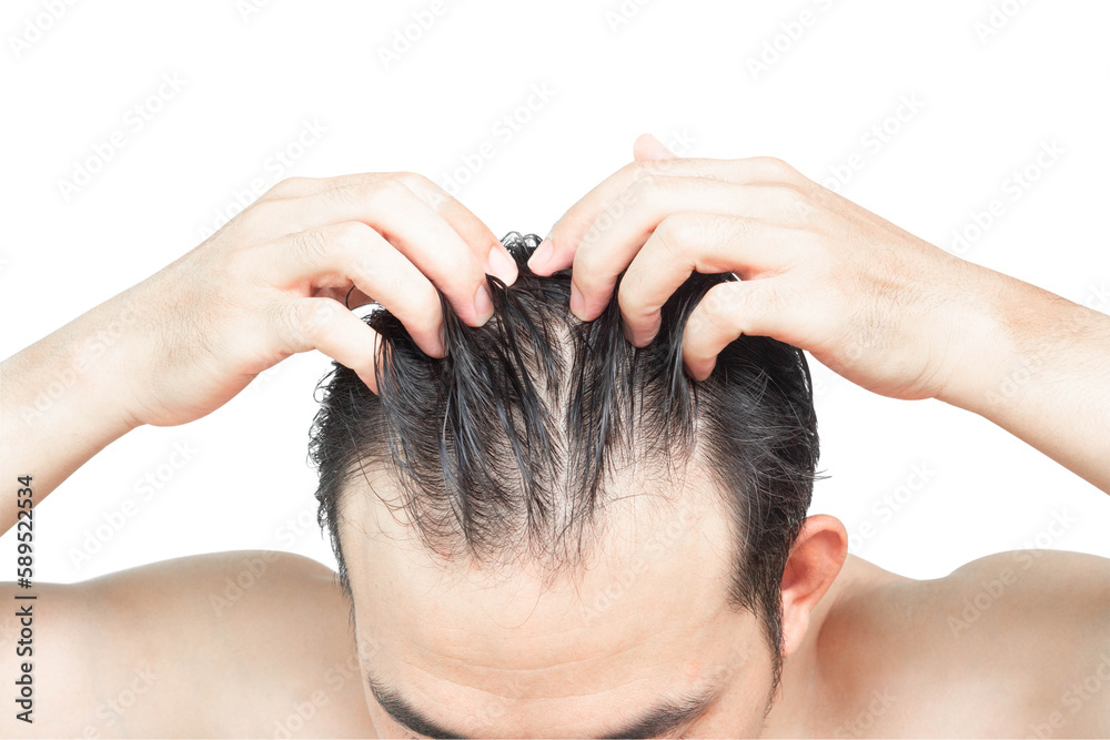 Fototapeta premium Closeup Young man serious hair loss problem with white backgroun for health care medical and shampoo product concept, selective focus