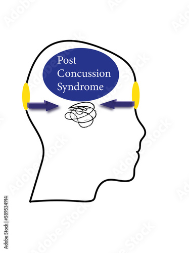 Post concussion syndrome after an traumatic brain injury