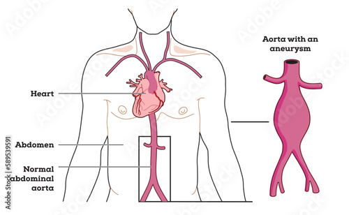 Location and appearance of an abdominal aortic aneurysm