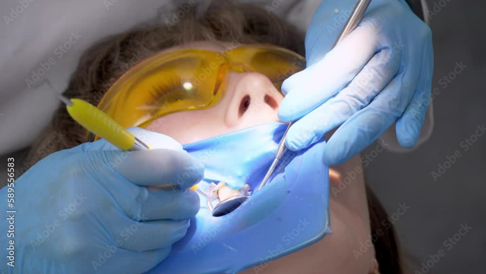 Wideo Stock Applying resin based composite filling on tooth. Young