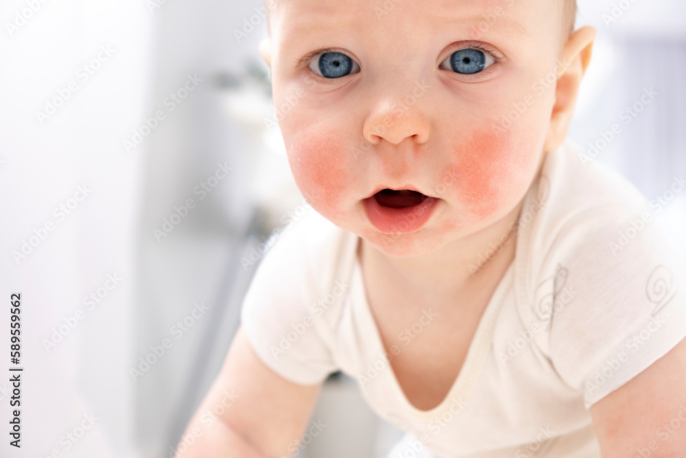 Baby face with allergic rash on cheeks. Atopic dermatitis. Eczema. Dry
