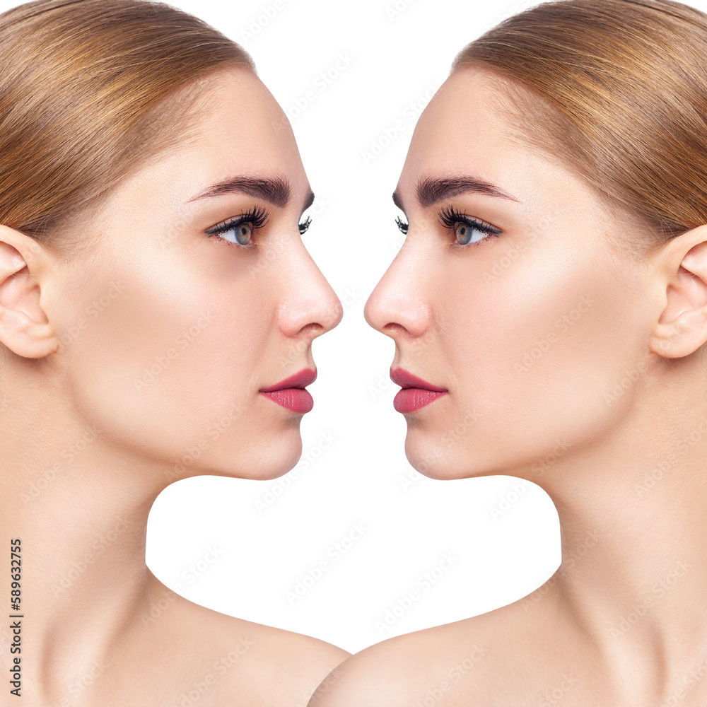 Young woman with bruises under eyes before and after treatment. Young woman with bruises under eyes before and after treatment.