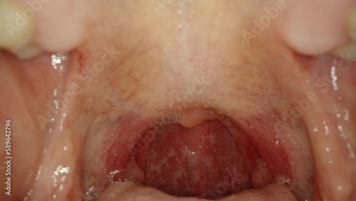 The man opens his mouth and the probe with the camera goes inside the mouth. Macro examination of the throat.