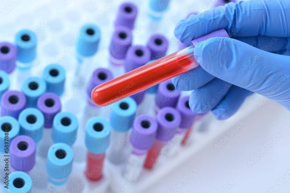 Hand with medical glove of doctor holds test tube with blood sample on the background of medical test tubes. Hand with medical glove of doctor holds test tube with blood sample on the background of medical test tubes.