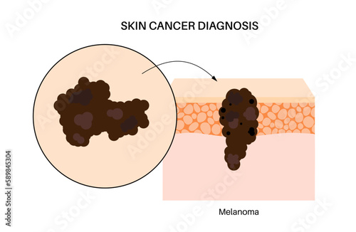 Skin cancer diagnosis