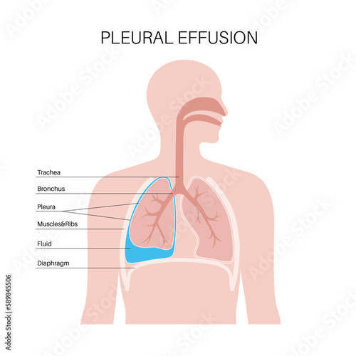 Pleural effusion poster