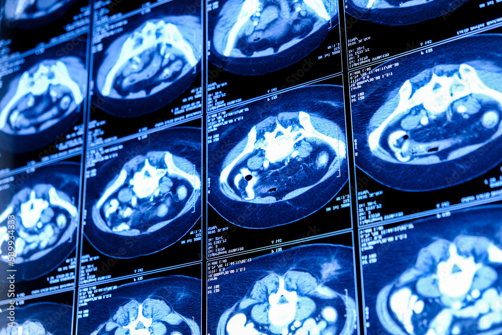 Photo & Art Print Computed tomography (CT scan) of chest with abdomen, elif