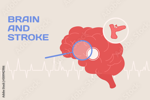 Brain and stroke concept illustration and poster in flat style