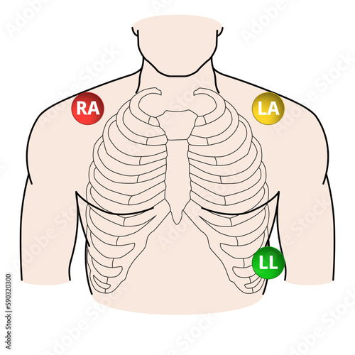 ECG 3-Wire Cable Lead Position - RA,LA,LL - Vector Medical Illustration