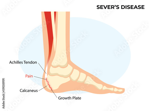 Sever's disease, calcaneal apophysitis. Ankle injury broken bone photo