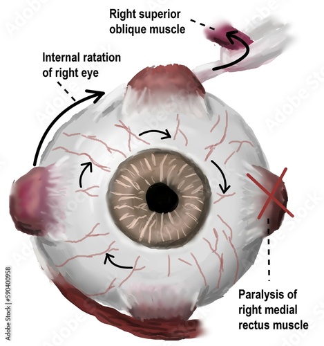 The function of superior oblique muscle of right eye in eye movement. photo