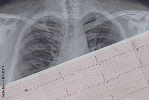 Fluorographic image of the lungs on paper close-up and a cardiogram on paper, healthy human lungs for a routine examination, health photo