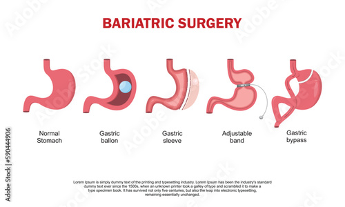 Stomach with adjustable gastric band device. Bariatric surgery weight loss procedure. Stomach reduction anatomical diagram infographic. Health care medical concept. Vector illustration