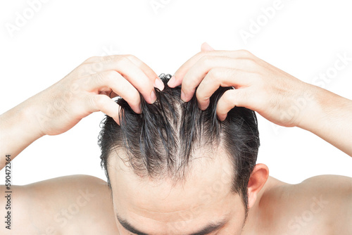 Closeup Young man serious hair loss problem with white backgroun for health care medical and shampoo product concept, selective focus