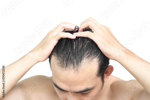 Closeup Young man serious hair loss problem with white backgroun for health care medical and shampoo product concept, selective focus