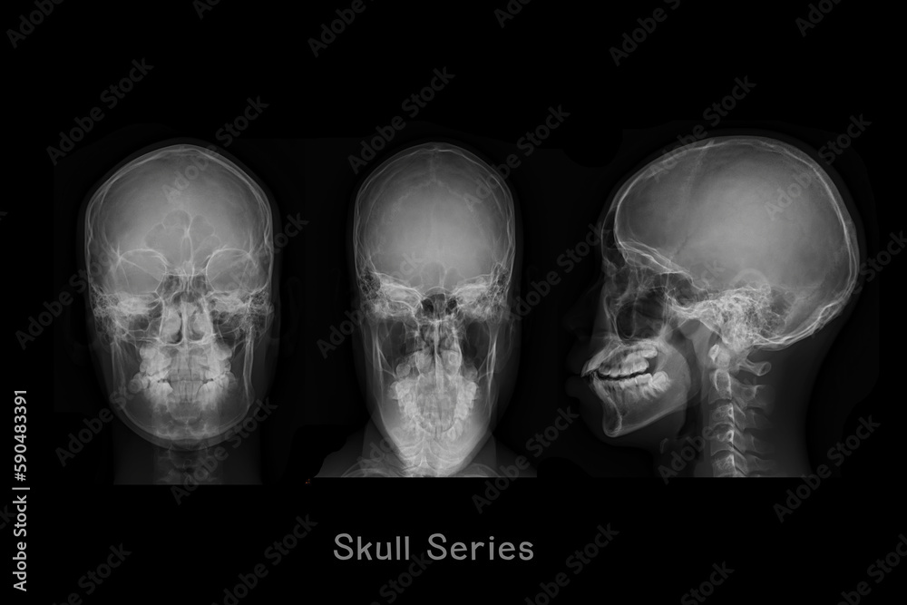 x-ray image of Skull AP,Town's and Lateral view or Skull series for diagnosis skull fracture isolated on Black Background. x-ray image of Skull AP,Town's and Lateral view or Skull series for diagnosis skull fracture isolated on Black Background.