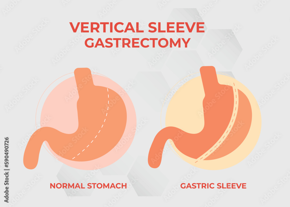 Laparoscopic Sleeve Gastrectomy Vertical Gastrectomy Weight Loss laparoscopic-sleeve-gastrectomy-vertical-gastrectomy-weight-loss