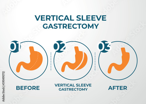 Laparoscopic Sleeve Gastrectomy, Vertical Gastrectomy, Weight loss surgery Vector Illustration of Stomach reduction surgery