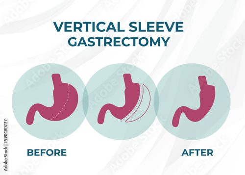 Laparoscopic Sleeve Gastrectomy, Vertical Gastrectomy, Weight loss surgery Vector Illustration of Stomach reduction surgery