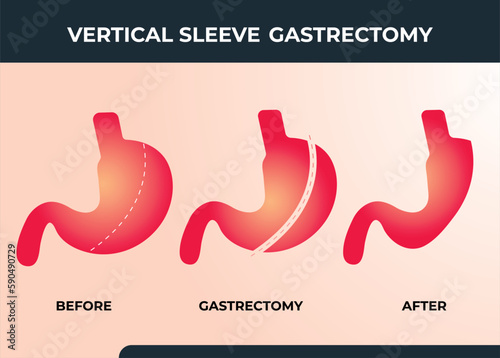 Laparoscopic Sleeve Gastrectomy, Vertical Gastrectomy, Weight loss surgery Vector Illustration of Stomach reduction surgery