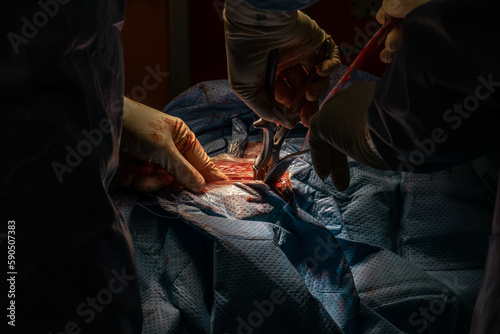 Hip Surgery in Progress: Detailed Footage of Surgeons in the Operating Room