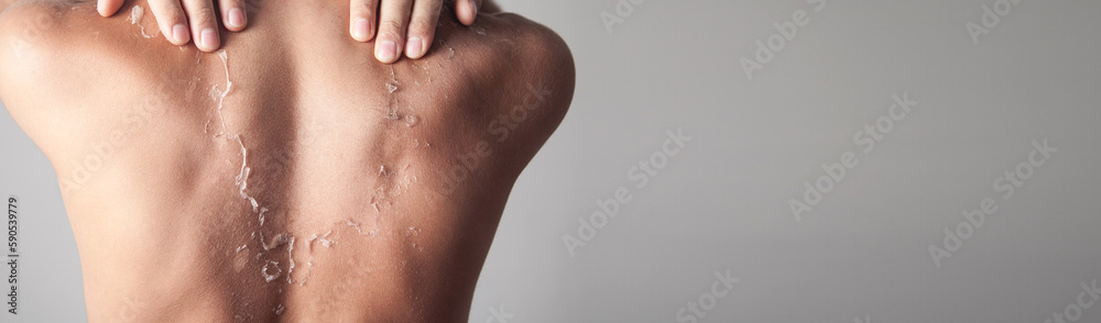 Fototapeta premium Man with peeling skin from sunburn.