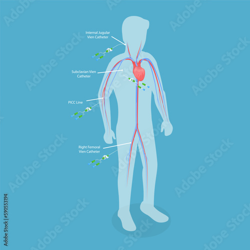 3D Isometric Flat Vector Conceptual Illustration of PICC Line , Central Venous Catheter