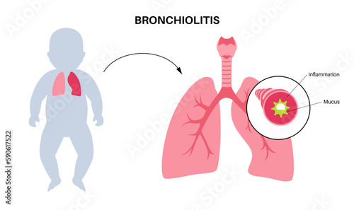 Bronchiolitis lung disease