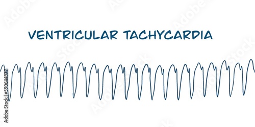 ECG example of monomorphic VT