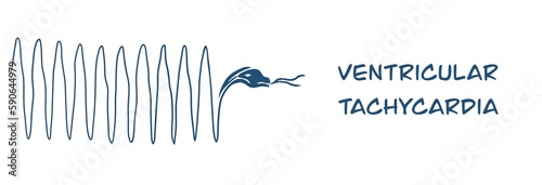 monomorphic ventricular tachycardia findings on electrocardiogram with snake vector illustration