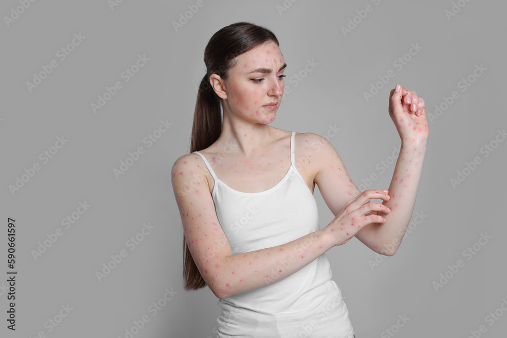 Woman with rash suffering from monkeypox virus on light grey background Woman with rash suffering from monkeypox virus on light grey background