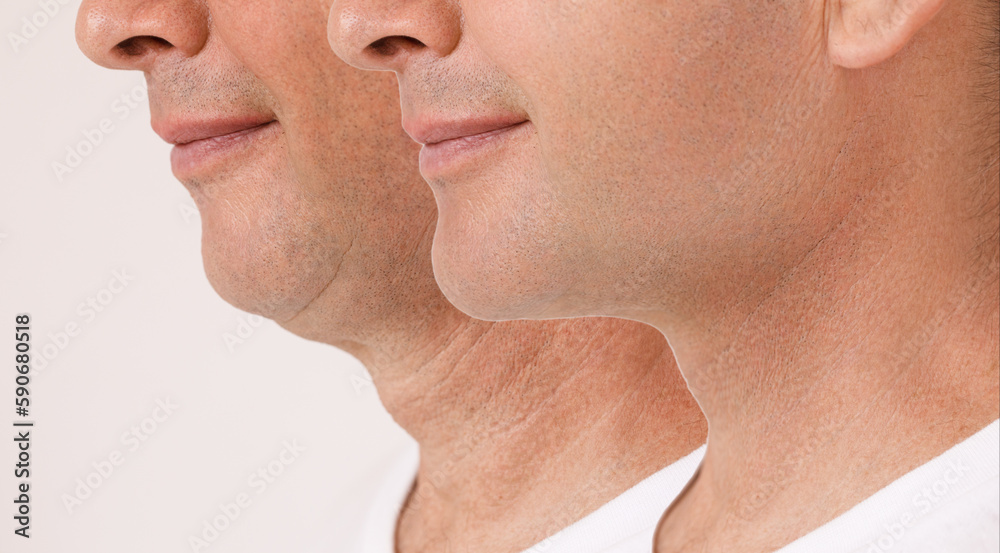 Φωτογραφία A close portrait of an aged man before and after the facial rejuvenation procedure