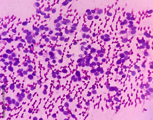USG guided FNA cytology from liver SOL. Non-Hodgkin lymphoma. Smear show atypical small round cells and inflammatory cells and blood background. Metastatic carcinoma.