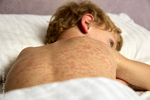 Sad boy lies on the bed in the room, his whole body covered with red allergic spots. A small child has a hard time tolerating chickenpox, the whole body is in a red rash photo