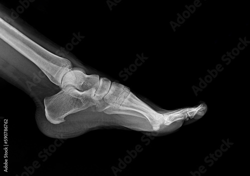 X-ray of the foot bones of a 22-year-old woman, heel spur