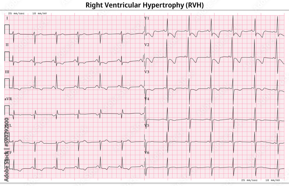 ECG Right Ventricular Hypertrophy (LVH) - Right Ventricular Enlargement - 12 Lead ECG Common Case - 6 Sec/lead - Medical Vector Illustration ECG Right Ventricular Hypertrophy (LVH) - Right Ventricular Enlargement - 12 Lead ECG Common Case - 6 Sec/lead - Medical Vector Illustration