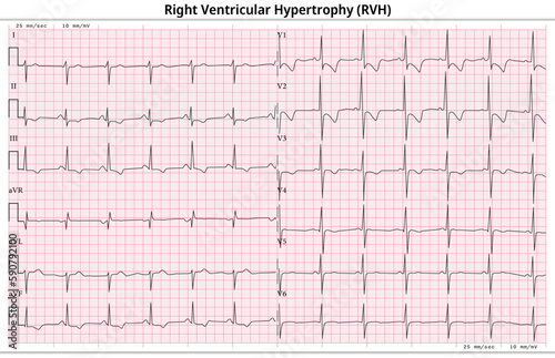 ECG Right Ventricular Hypertrophy  LVH  - Right Ventricular Enlargement - 12 Lead ECG Common Case - 6 Sec lead - Medical Vector Illustration
