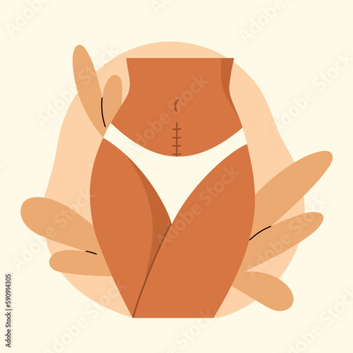 Cesarean scar. Stitches after caesarean section on female belly. C-section, surgical delivery operation concept. Vector illustration in cartoon style. Isolated white background.	
