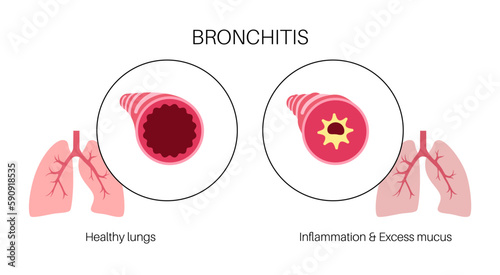Bronchitis lung disease
