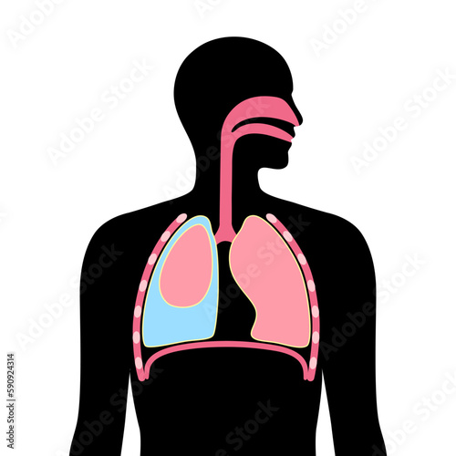 Pleural effusion poster