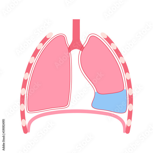 Pleural effusion poster