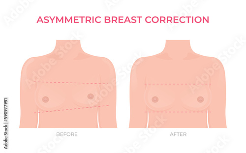 Asymmetric breast correction before and after plastic surgery front view