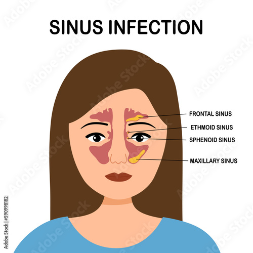Sinusitis or sinus infection infographic in flat design on white background.